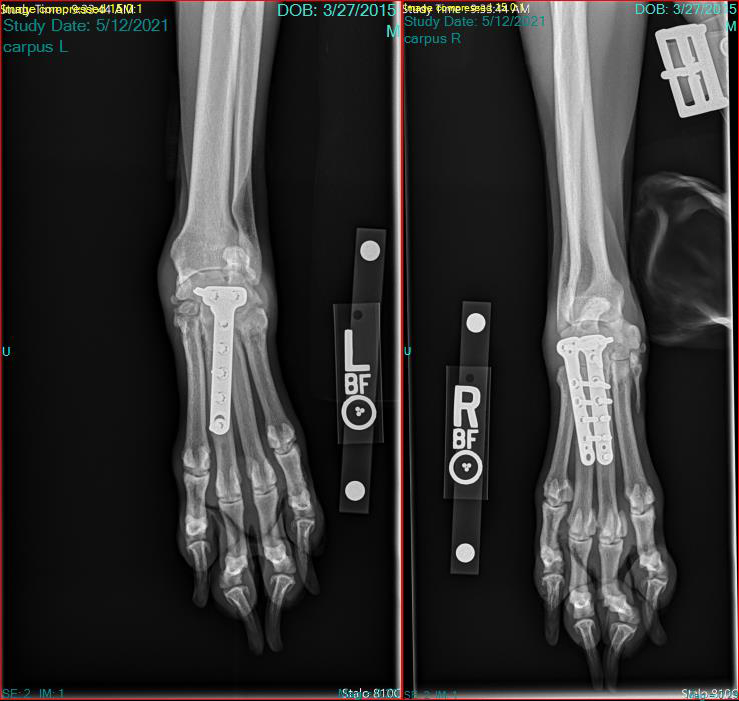X-ray of the plates in Jax' wrists.